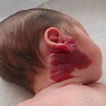 Младенческая гемангиома