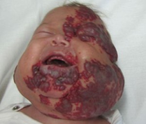 Как выглядит младенческая гемангиома?