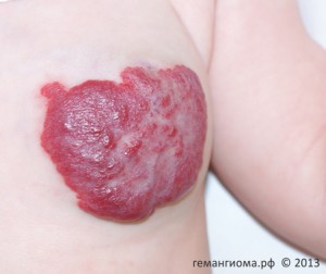 Комбинированная младенческая гемангиома в области грудной железы слева.