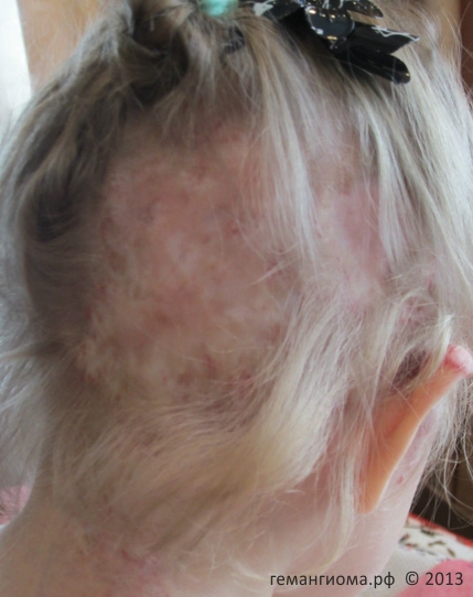 Многократная криодеструкция на волосистой части головы девочки привела к образованию огромных участков отсутствия волос, при этом под рубцами оставались элементы гемангиомы, которые продолжали расти после данного вида "лечения".