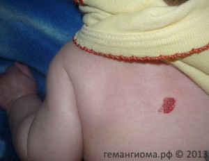 Младенческая гемангиома в области спины.
