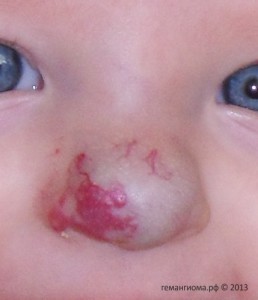 Комбинированная младенческая гемангиома в области носа.