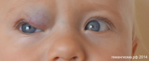 Младенческая гемангиома и нарушение зрения.