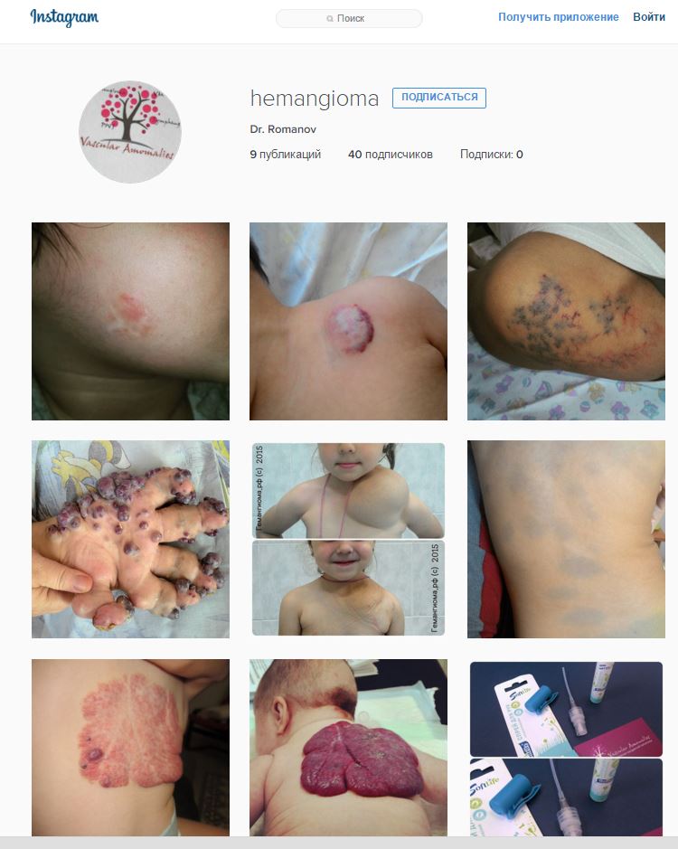 instagram_hemangioma
