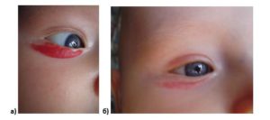 Местное применение неселективного бета-блокатора в лечении детей с младенческими гемангиомами области орбиты и век